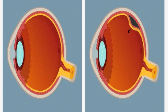 Retinal detachment surgery in Turkey Retinal detachment surgery in Turkey