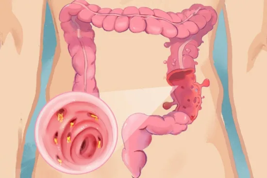 Treatment options for colonic diverticulosis in Turkey 2026 Treatment options for colonic diverticulosis in Turkey 2026
