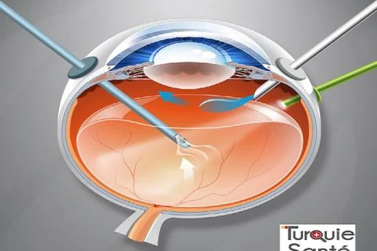 tratamiento del desprendimiento de retina en Turquía tratamiento del desprendimiento de retina en Turquía