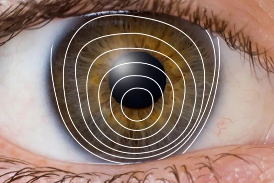 Cost of keratoconus surgery Cost of keratoconus surgery