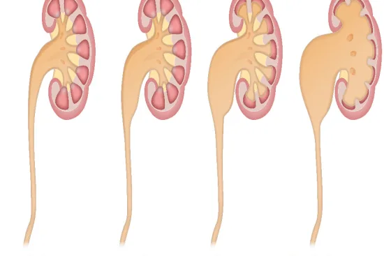 Hydronephrosis treatment in Turkey 2026 Hydronephrosis treatment in Turkey 2026