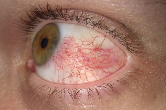 uveitis symptoms uveitis symptoms