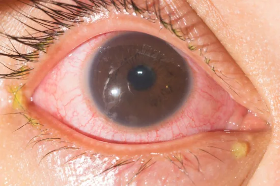 uveitis treatment uveitis treatment