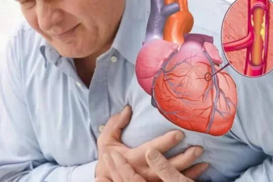 cardiopatía coronaria cardiopatía coronaria