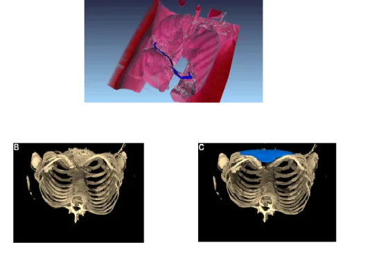 Pectus Excavatum Treatment Options 2026 Pectus Excavatum Treatment Options 2026
