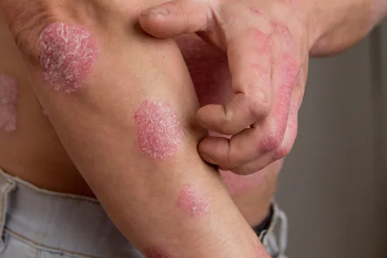 Skin disease Skin disease