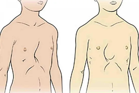 Poland syndrome treatment Poland syndrome treatment